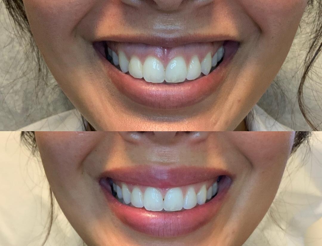 Natural-Looking Lip Volume
