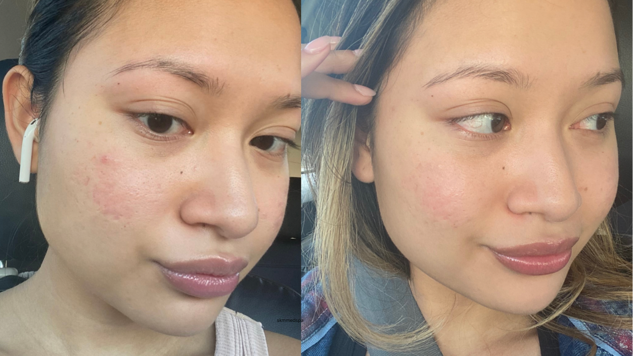 SKM MedSpa real patient result 2