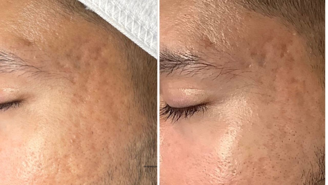 SKM MedSpa real patient result 3