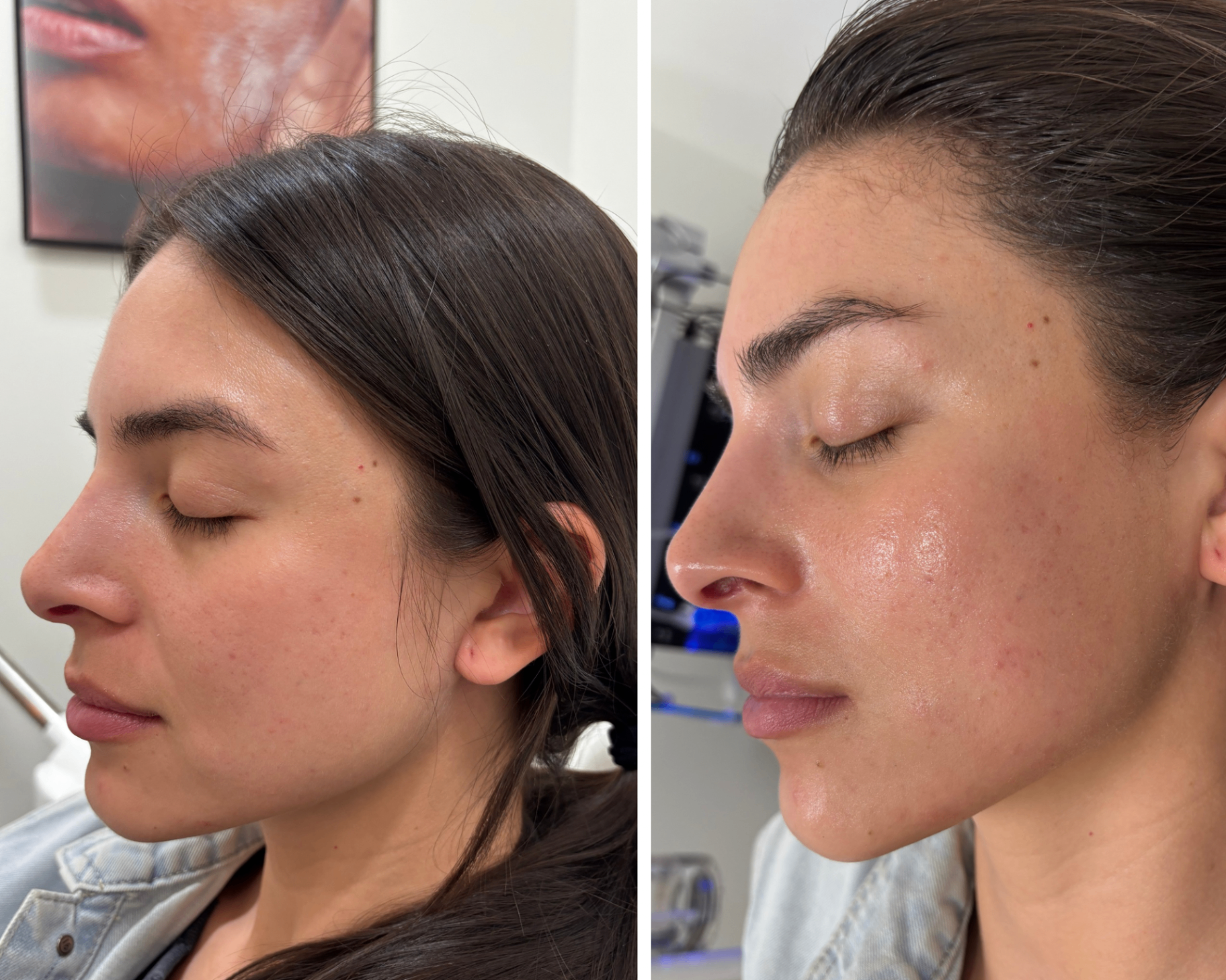Resurfaced, Refreshed Skin